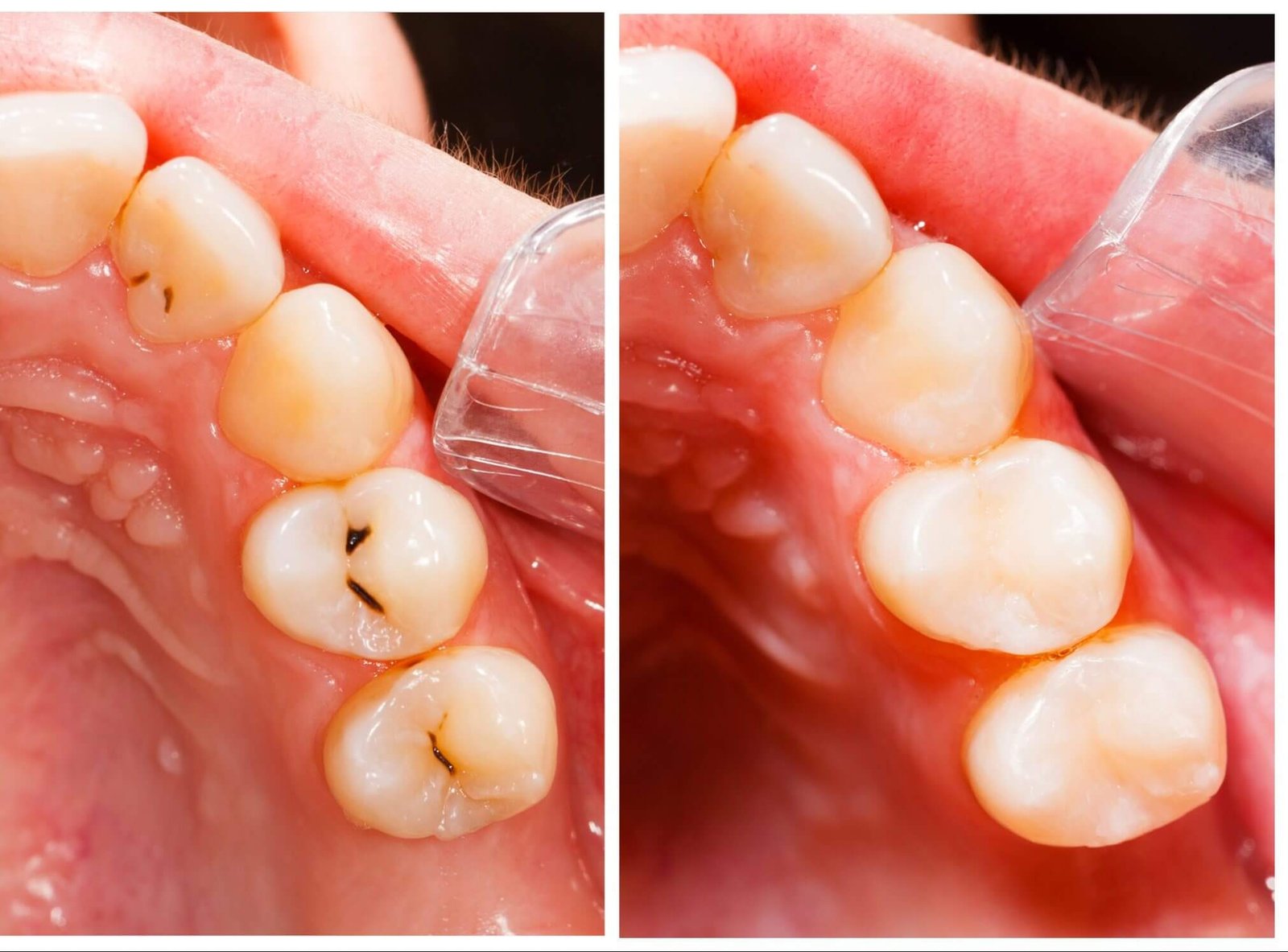 Custom Date Cavities